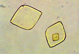 Cristales de ácido úrico